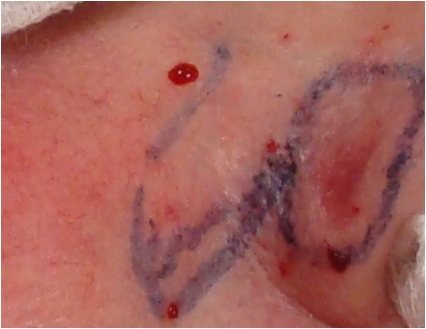 Basal cell carcinoma of the nose